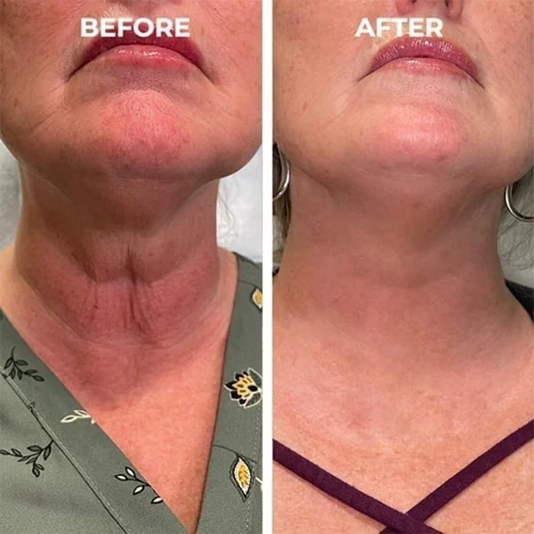 š„Limited Time Offer š„70% OFFš„ - Botox Face Serum