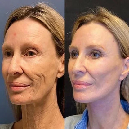 🔥Limited Time Offer 🔥70% OFF🔥 - Botox Face Serum