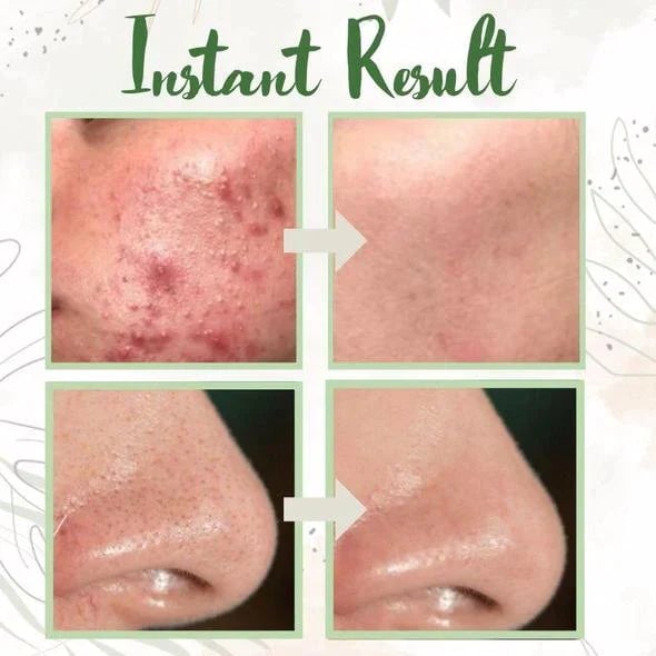Last Day 49%OFF- ✨Green Tea Deep Cleanse Mask