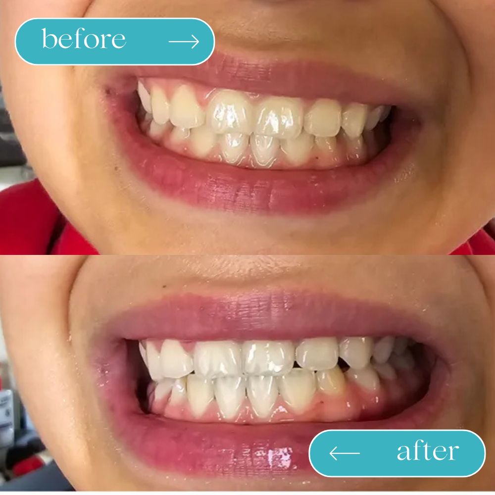 Guru Nanda™️ Coconut Oil Pulling w/ Essential Oils (FREE GIFTS INCLUDED TODAY)